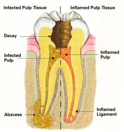 Endodontic Procedure