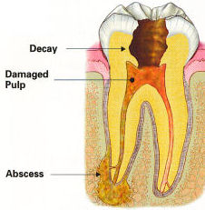 Endodontic Procedure