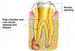 Endodontic Procedure