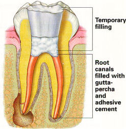 Endodontic Procedure