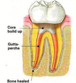 Endodontic Procedure