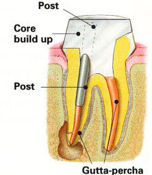 Endodontic Procedure